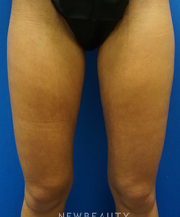 dr-niki-christopoulos-liposuction-b