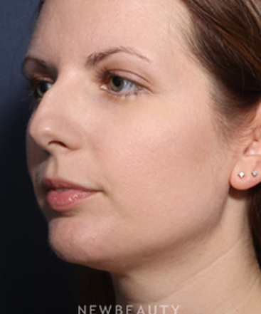 ljcsc-dr-wheeler-rhinoplasty-b