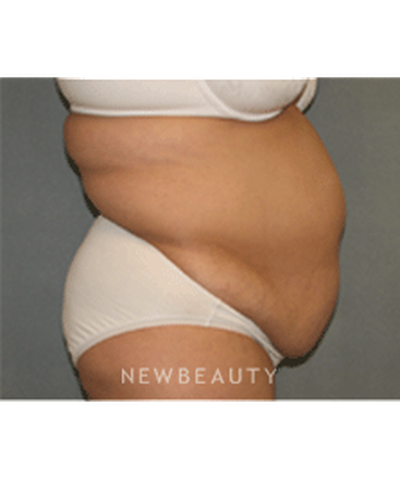 dr-sean-simon-tummy-tuck-lipo-b