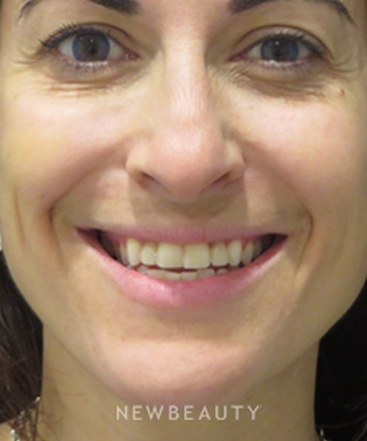 dr-kim-nichols-restylane-refyne-b