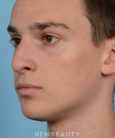 dr-jeffrey-wise-rhinoplasty-b
