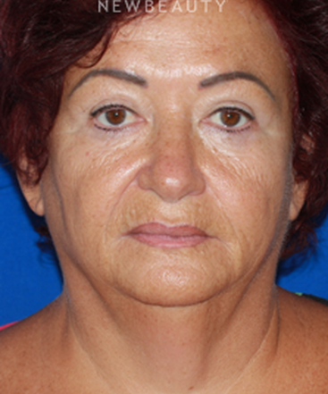 dr-konstantin-vasyukevich-lower-facelift-b