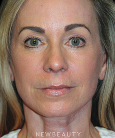 dr-brent-smith-mini-facelift-lasers-b