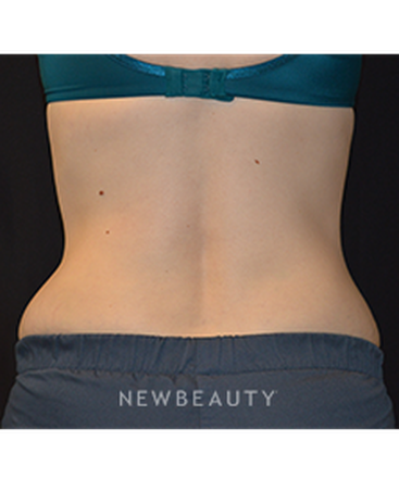 dr-kim-nichols-coolsculpting-b