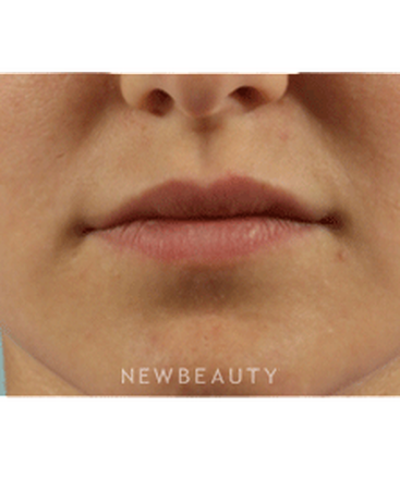 dr-marina-peredo-lip-augmentation-b