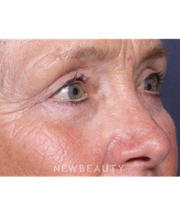 ljcsc-dr-smoot-eyelift-b