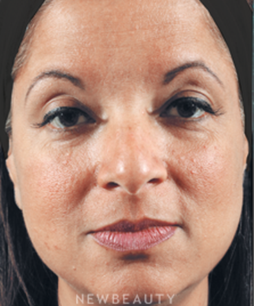dr-marina-peredo-injectables-fillers-b