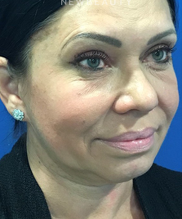 dr-dilip-madnani-facelift-necklift-b
