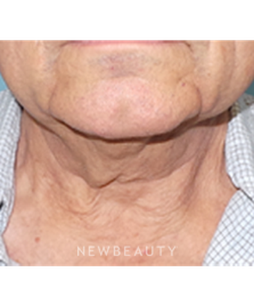 dr-sean-simon-precision-neck-lift-b