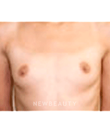 dr-sanjay-grover-breast-augmentation-b