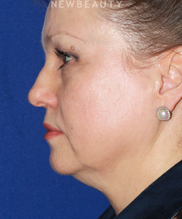dr-konstantin-vasyukevich-facelift-b