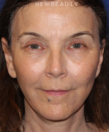 dr-dilip-madnani-facelift-necklift-b