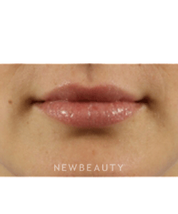 dr-marina-peredo-lip-augmentation-b