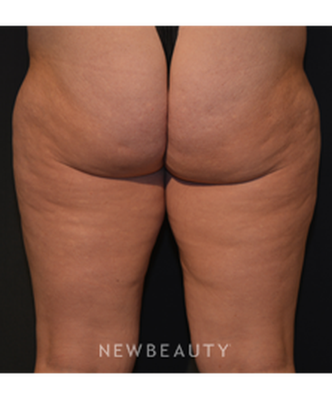 dr-janet-allenby-body-sculpting-b