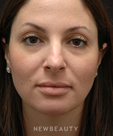 dr-jeffrey-b-wise-rhinoplasty-b