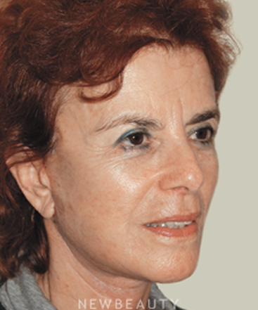 dr-david-rapaport-facelift-necklift-b