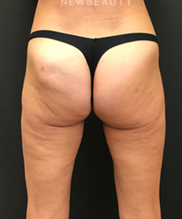 dr-janet-allenby-emsculpt-b