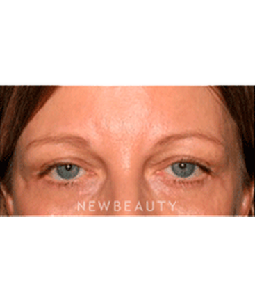 dr-sanjay-grover-blepharoplasty-b