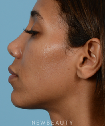 dr-jeffrey-b-wise-nasal-tip-refinement-b
