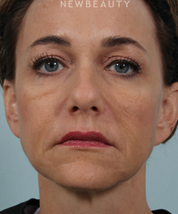 dr-kenneth-beer-liquid-facelift-b