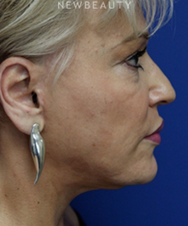 dr-joseph-russo-full-face-rejuvenation-face-ebg-b