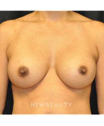 dr-andrew-smith-breast-augmentation-b