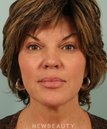 dr-kenneth-beer-injectables-fillers-restylane-b