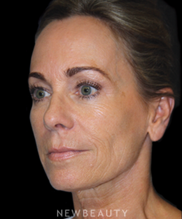 dr-brent-smith-mini-facelift-lasers-b