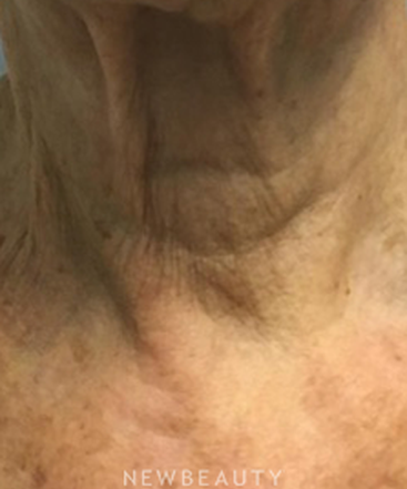 dr-marina-peredo-botox-b
