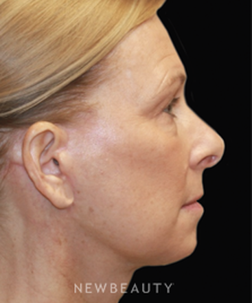 dr-dilip-madnani-facelift-b