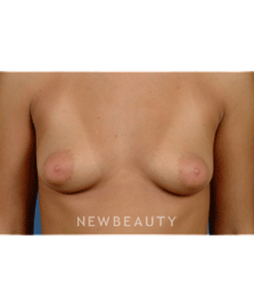 dr-bradley-calobrace-breast-augmentation-b