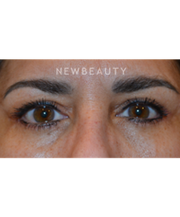 dr-baljeet-purewal-blepharoplasties-b