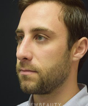 dr-jeffrey-b-wise-rhinoplasty-b