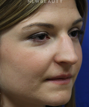 dr-jennifer-levine-rhinoplasty-b