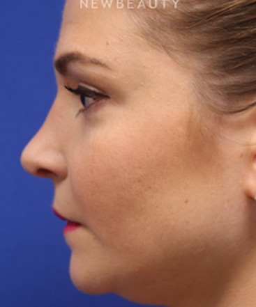 dr-jennifer-levine-rhinoplasty-b