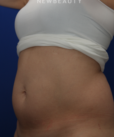 dr-jennifer-levine-sculpsure-b