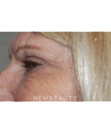 dr-marina-peredo-elos-injectionsliquid-lift-b