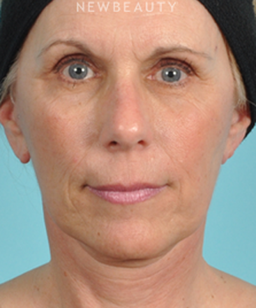 dr-bradley-bengtson-facelift-b