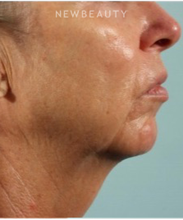 dr-marina-peredo-firmatherapy-for-sagging-skin-b