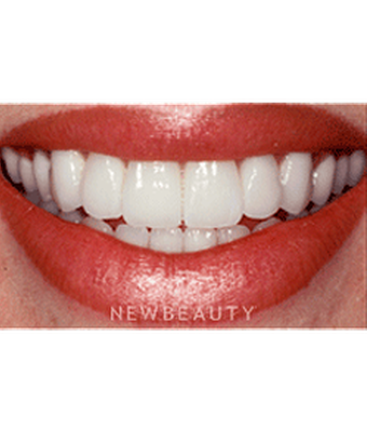 dr-laurence-rifkin-veneers-b