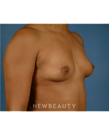 dr-bradley-calobrace-breast-augmentation-b