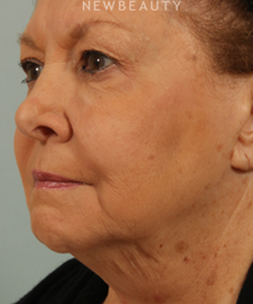 dr-kenneth-beer-coolsculpting-b