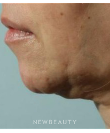 dr-marina-peredo-necklift-b