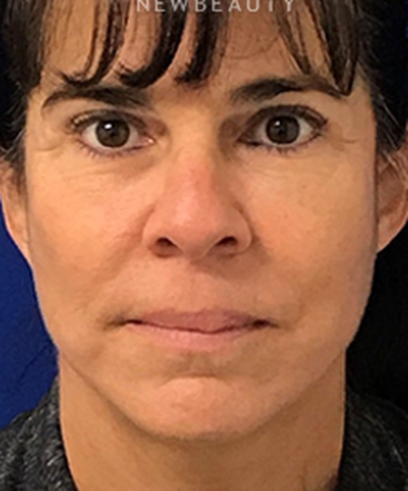 dr-dilip-madnani-facelift-necklift-b