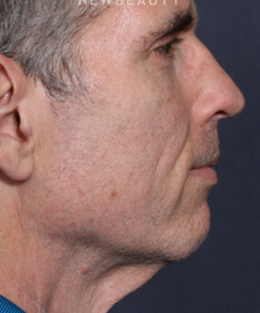 ljcsc-dr-brahme-facelift-b