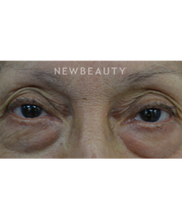dr-baljeet-k-purewal-blepharoplasty-b