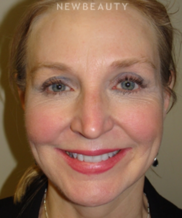 dr-sanjay-grover-blepharoplasty-b