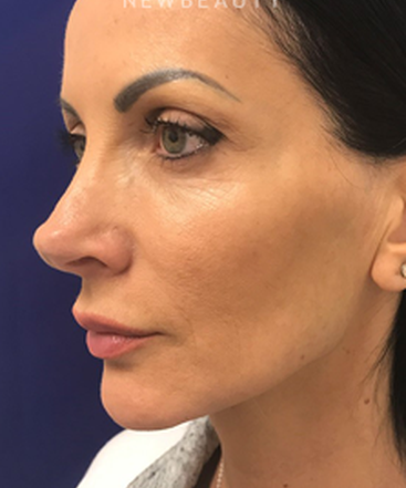 dr-dilip-madnani-minilift-injectables-b