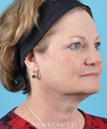 dr-brad-bengtson-facelift-b