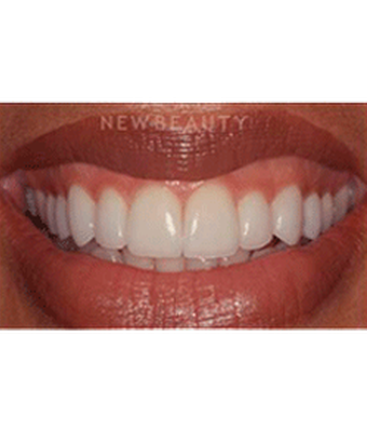 dr-laurence-rifkin-veneers-b